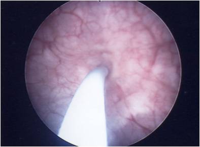 Injektion von Botulinum-Toxin (Botox) in die Blasenwand während einer Blasenspiegelung in Narkose