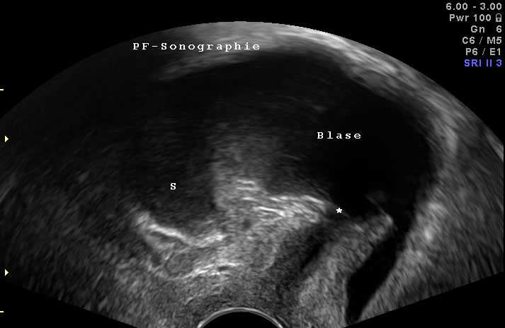 Senkung in der Vaginalsonographie: ein Teil der Blase sinkt unterhalb des Harnröhreneinganges (s. Stern) ab.